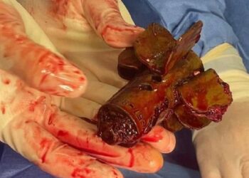 Хірурги польового шпиталю дістали з тіла захисника хвостик міни