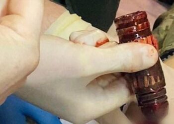 Басқа күрескердің денесінен дәрігерлер снарядтың варварын алып тастады