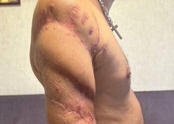 Близько 40% поранених захисників мають ушкодження кінцівок