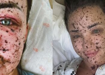 Операторка FPV-дронів опублікувала світлини після поранення на фронті. Фото дня