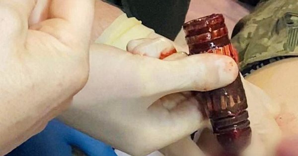 Iz trupla drugega lovca so zdravniki odstranili bojno glavo iz projektila.