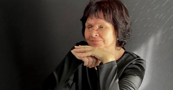 Львівські лікарі відновлюють учительці з Лисичанська понівечене війною обличчя (фото)