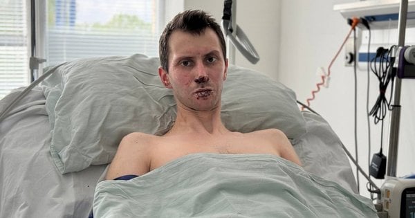 Львівські комбустіологи врятували 30-річного захисника з Волині, який обпік 50% тіла